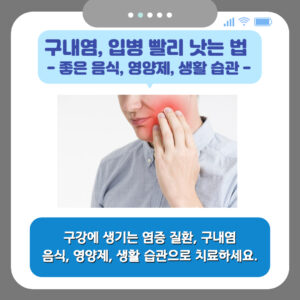 구내염, 입병 빨리 낫는 법