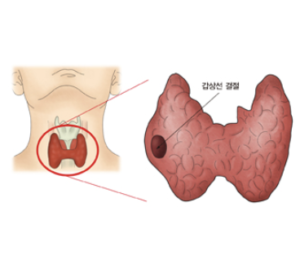 갑상선 결절